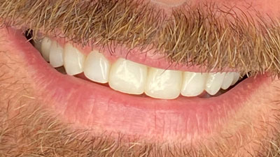 coroas-de-ceramica-reabilitacao-oral2